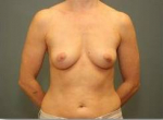 BREAST AUGMENTATION: Case 28 Before